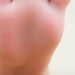 Photograph of a foot with a bunion on display.